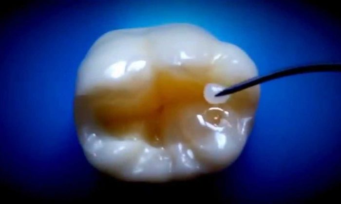 реставрация зуба