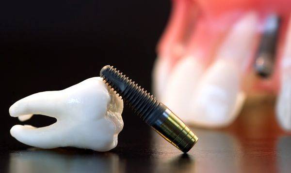 Удаление зуба и одномоментная имплантация – плюсы и минусы