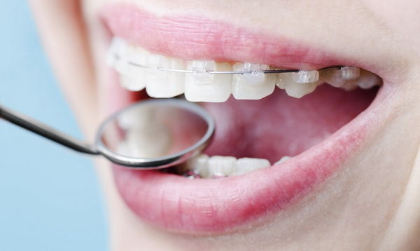 Керамические и сапфировые брекеты: какие лучше для коррекции прикуса и выравнивания зубов