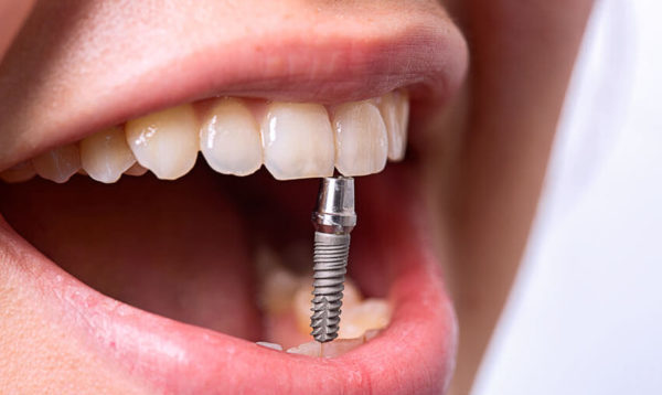 Чем выгодна имплантация зубов «под ключ»
