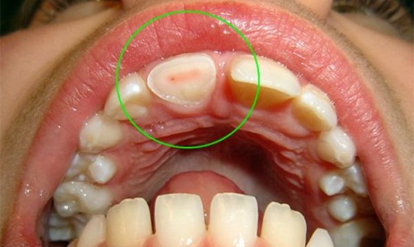 травмированный зуб