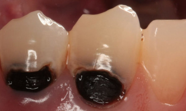 Кариес корня зуба: чем он опасен, симптомы, диагностика
