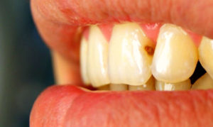 лечение передних зубов