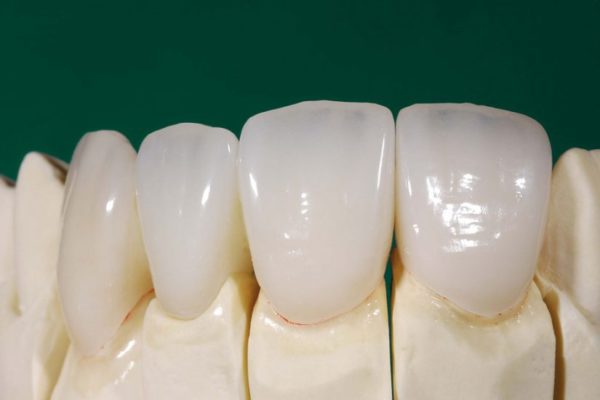 Виды зубных коронок и в каких случаях они используются