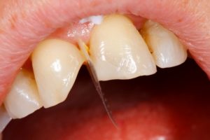 травмирования зуба