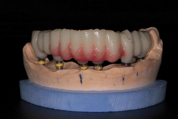 Имплантация зубов с помощью методики All-ON-6