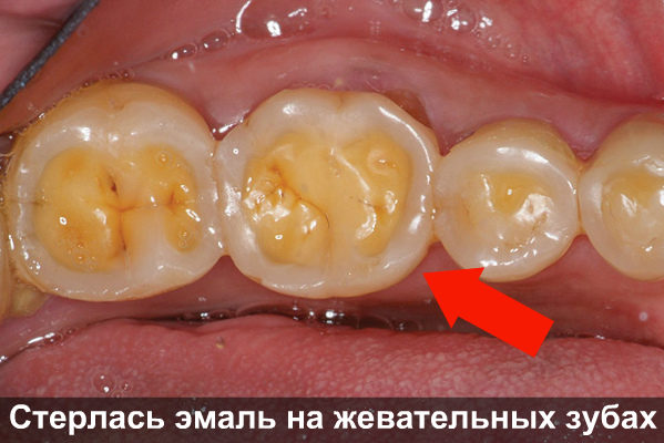 Патологическая стираемость зубов – причины, методы лечения