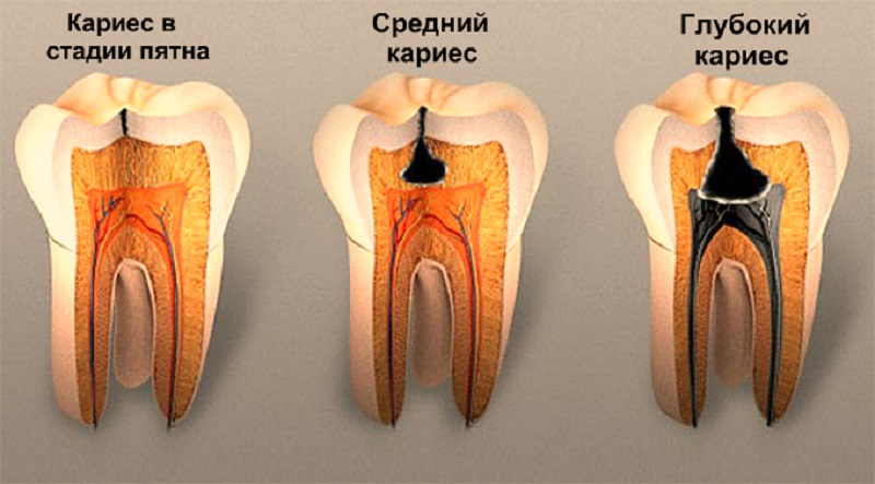 Как классифицируется кариес в стоматологии